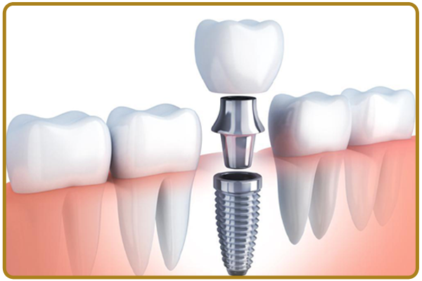 Dental Implants at Precious 32 Dental Clinic